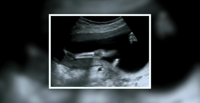 Close-up view of ultrasound monitor showing fetus image at three months of pregnancy