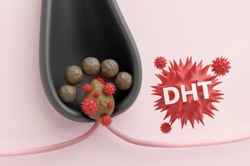 DHT hormone attacking the dermal papilla causing hair follicle miniaturization 3D render