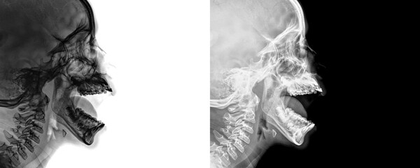 X-Ray of Nasopharynx in Lateral View Displaying Airway Narrowing and Adenoid Enlargement for Chronic Adenoiditis Diagnosis Isolated on Transparent Background