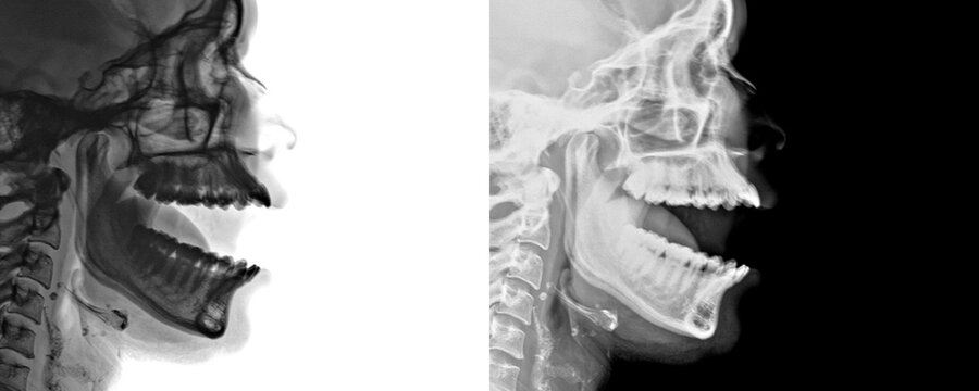 Lateral Projection Nasopharynx X-Ray Showing Soft Tissue Outline and Adenoid Hypertrophy for Diagnosis of Chronic Adenoiditis Isolated on Transparent Background