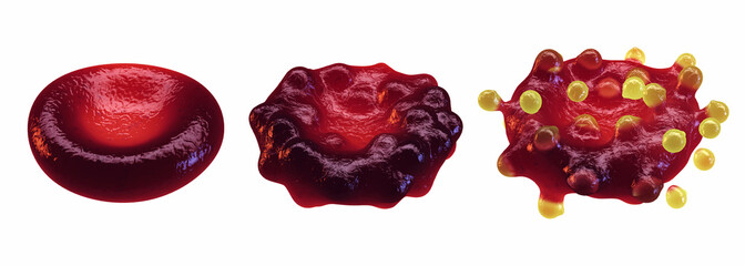 Malaria infected red blood cell at different stages of development. Healthy/Infected/Lysed blood cell, isolated on white. Merozoites, the invasive blood stage of Plasmodium Falciparum parasite.
