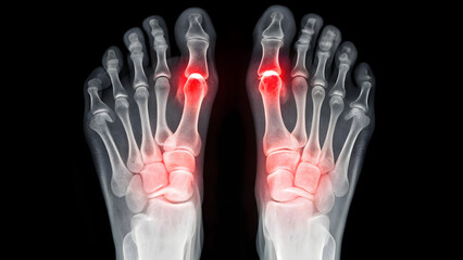 Bilateral feet X-ray highlighting hallux valgus