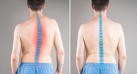 Man before and after spine curvature correction, scoliosis treatment comparison