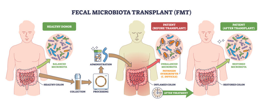 Fecal microbiota transplant (FMT) shown from donor to patient, stool processing and administration restore gut microbiota, key objects, intestines, capsules, bacteria. Outline diagram