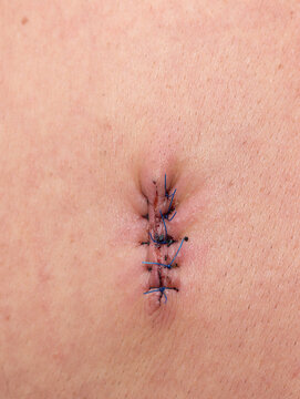 Detailansicht einer medizinischen Naht auf der Haut nach Operation am R&uuml;cken