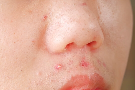 ニキビや吹き出物に悩む子供の肌