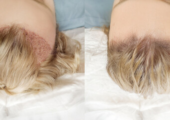 Hair Transplant Surgery.Hair Transplantation and Restoration