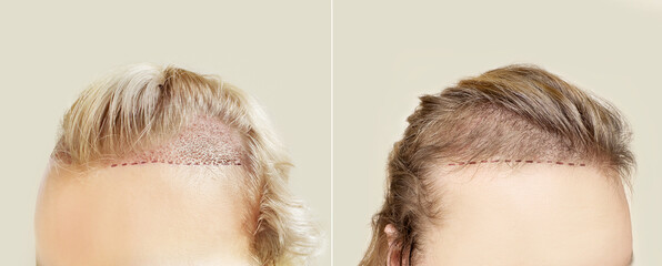 Hair Transplant Surgery.Hair Transplantation and Restoration