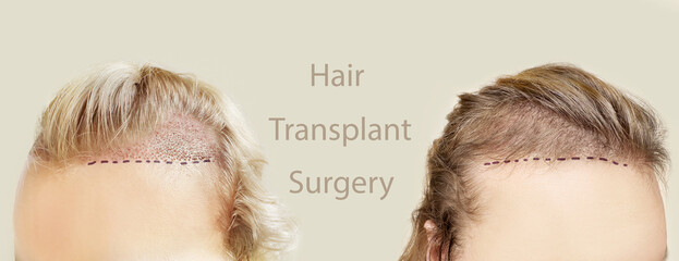 Hair Transplant Surgery.Hair Transplantation and Restoration