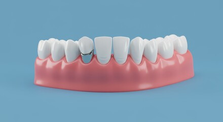 Fototapeta premium Close up of a dental model showing a missing tooth and a crown on an adjacent tooth against a blue background