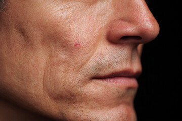 Obraz premium Closeup of a mans face with a small red spot near his nose