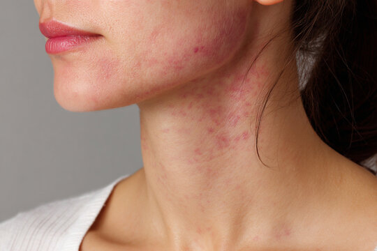 Woman with rosacea on face and neck, showing redness and skin inflammation