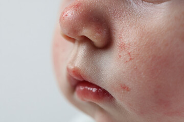 Closeup of a baby's face showing a skin rash, isolated on white background
