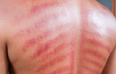 Red marks from scraped coin on a man's back. Javanese traditional alternative non-medical treatment to treat symptoms of colds called Kerokan.