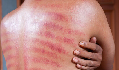 Red marks from scraped coin on a man's back. Javanese traditional alternative non-medical treatment to treat symptoms of colds called Kerokan.
