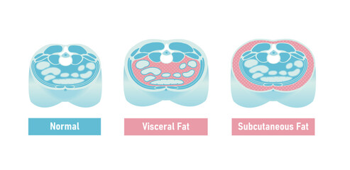 Abdominal cross section illustration of subcutaneous fat and visceral fat