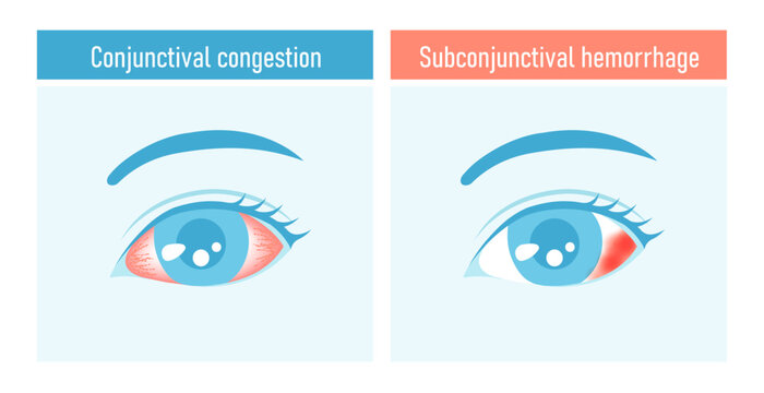 Eye vector illustration set (subconjunctival hemorrhage and conjunctival congestion)