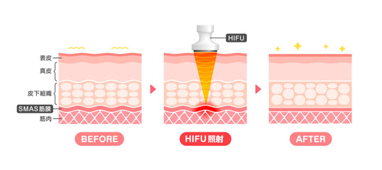 Vector illustration of HIFU mechanism and effect.