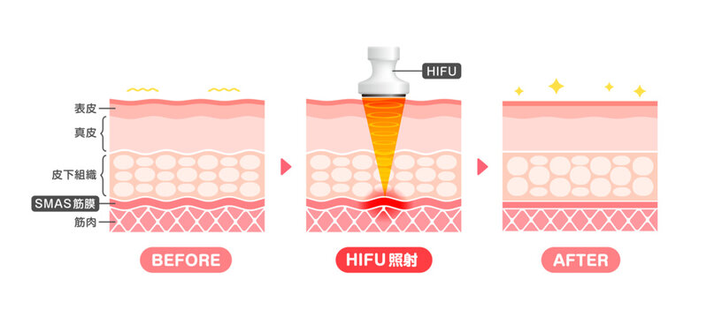Hifu」の写真素材 | 1,155件の無料イラスト画像 | Adobe Stock