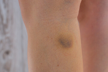 Unrecognizable woman with bruise on her leg. Close up of stain bruise wound on leg. Healing injury...