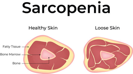 Sarcopenia Muscle Loss and Aging Vector Illustration