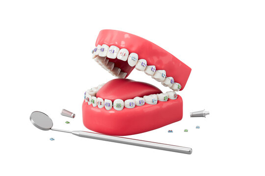 Orthodontic dental model with colorful braces and dental mirror tool, 3D Rendering, isolated on white background. Concept of dental care and alignment