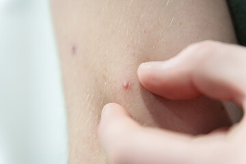 Fototapeta premium Fingers pressing on a small pimple on human skin, showing acne and skin imperfections up close.