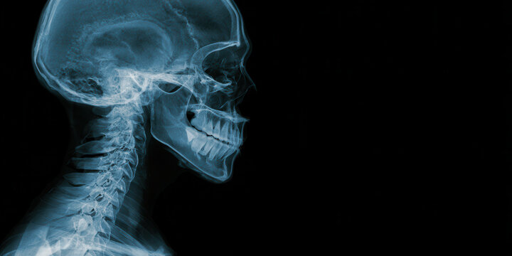 Skull xray lateral view, human head profile, cervical spine, medical diagnostic