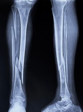AP and lateral X-rays of lower leg showing comminuted tibial shaft fracture with associated fibular fracture