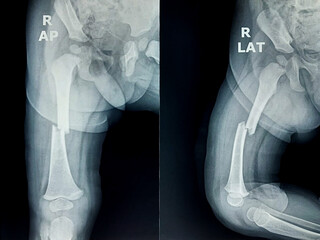 Pediatric femur X-ray showing displaced transverse fracture of femoral shaft