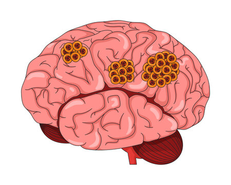 Human brain with cancerous tumors 2D vector illustration. Cancer cells on cerebral organ. Malignant pathology. Oncology education flat object isolated on white background. Colorful cartoon image