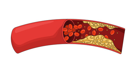 Fototapeta na wymiar Cholesterol plaque obstructing blood flow 2D vector illustration. Impeding red bloodcell circulation. Coronary artery disease flat object isolated on white background. Colorful cartoon image