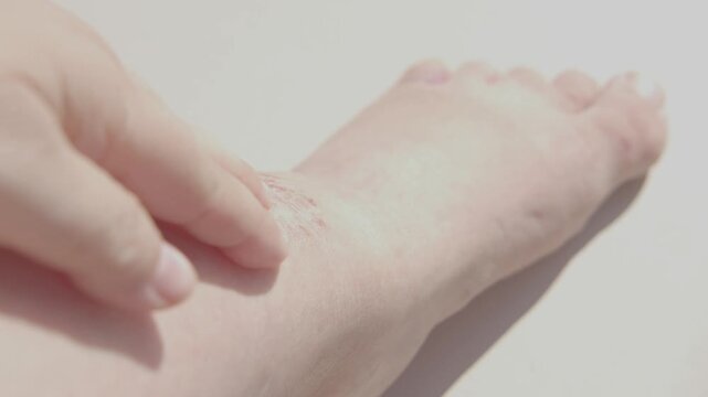 hand applies ointment to wounds, rash, hives, itchy skin on leg, inflammation, Medical Allergies, disease female patient, Dermatology Issues, skin problems on general physical and emotional well-being