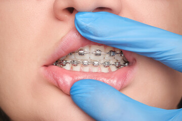 Dentist's gloved hand opening the mouth of a patient with metal bracket system on the teeth of a young woman. Concept of oral dental health care. Shallow depth of field