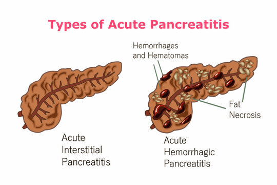 Types of Acute Pancreatitis, Hemorrhages and Hematomas, Fat Necrosis
