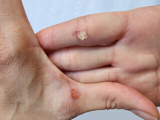 Hands with blisters, abrasions and scars on a white background