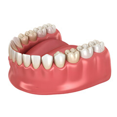 Obraz premium Human lower jaw with discolored teeth showing dental problems and gum inflammation isolated on transparent background