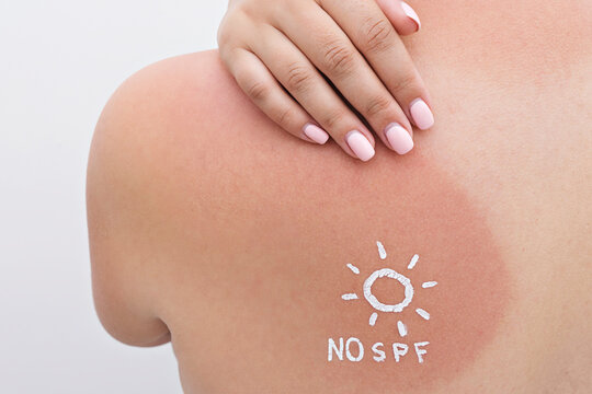 Closeup of red sunburn on shoulder with NO SPF sun symbol in cream, tender skin and UV exposure shown