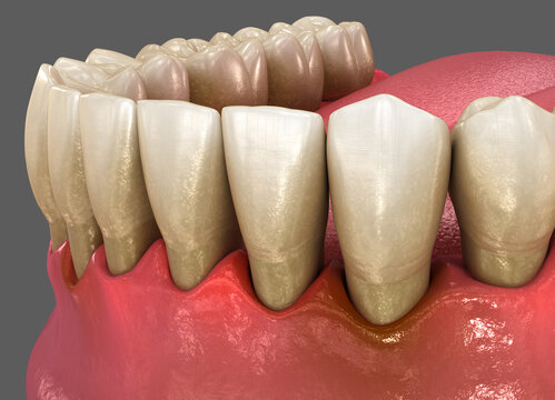 Gum recession, inflammation of the gums. Dental 3D illustration