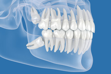 Impaction of Wisdom tooth. Dental 3D illustration