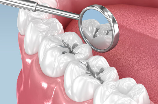 Amalgam tooth restoration. Dental 3D illustration