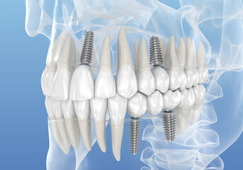 Teeth recovery with dental implant, transparent view. Medically accurate 3D illustration