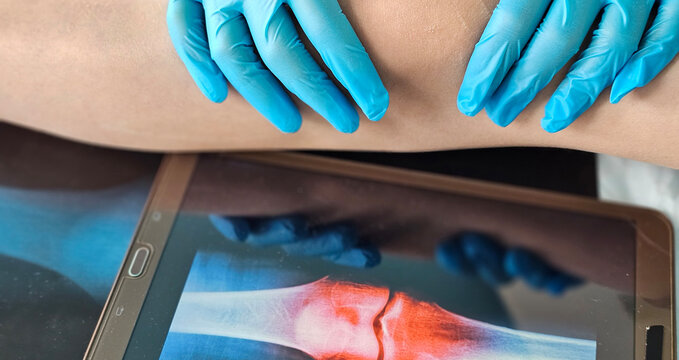 Doctor doing computer examination of knee joint using digital tablet - Powered by Adobe