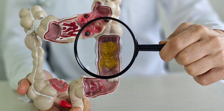 Colon model with different diseases in doctors hands