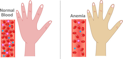 Anemia,  red blood cells or a decrease in the amount of hemoglobin in the blood. different skin colors on hand. Section showing normal and anemia blood contents in vessels. Vector illustration