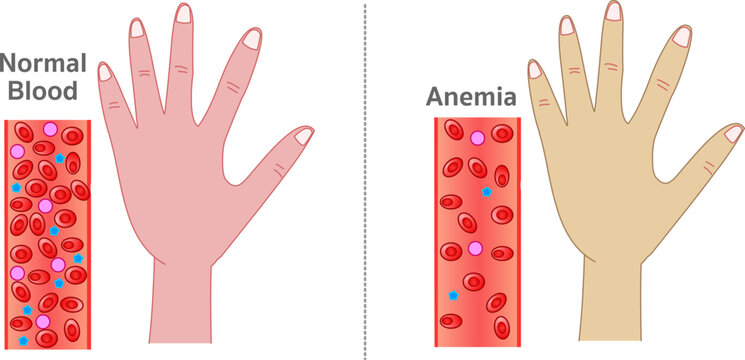 Anemia,  red blood cells or a decrease in the amount of hemoglobin in the blood. different skin colors on hand. Section showing normal and anemia blood contents in vessels. Vector illustration
