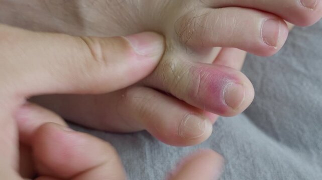 Swollen Purple bruise on the toe of male person foot. Injury of foot finger after home accident. Close-up of soft tissue edema and bruising on skin