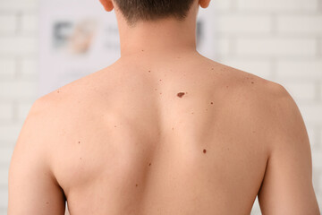 Naklejka premium Man's back with multiple moles and skin lesions dermatology and skin cancer awareness health and medical examination, this image a medical examination or checkup for potential melanoma and other skin