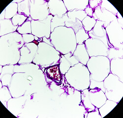 Lipoma, benign growth of fatty tissue, benign neoplasm, adipocytes, partially capsulated tumor, 40x microscopic view.