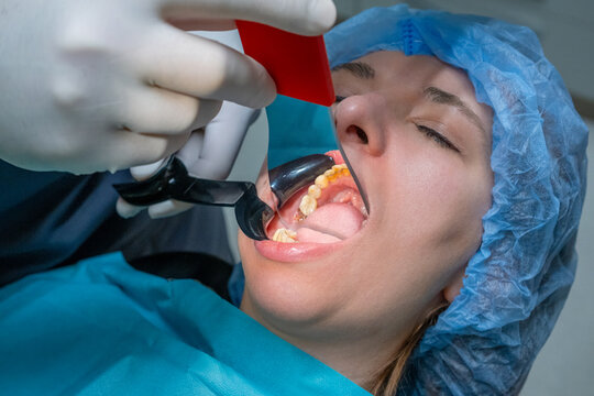 Dental professional uses mouth prop to keep patient mouth open during procedure. Woman wearing surgical cap undergoes dental treatment in hospital.